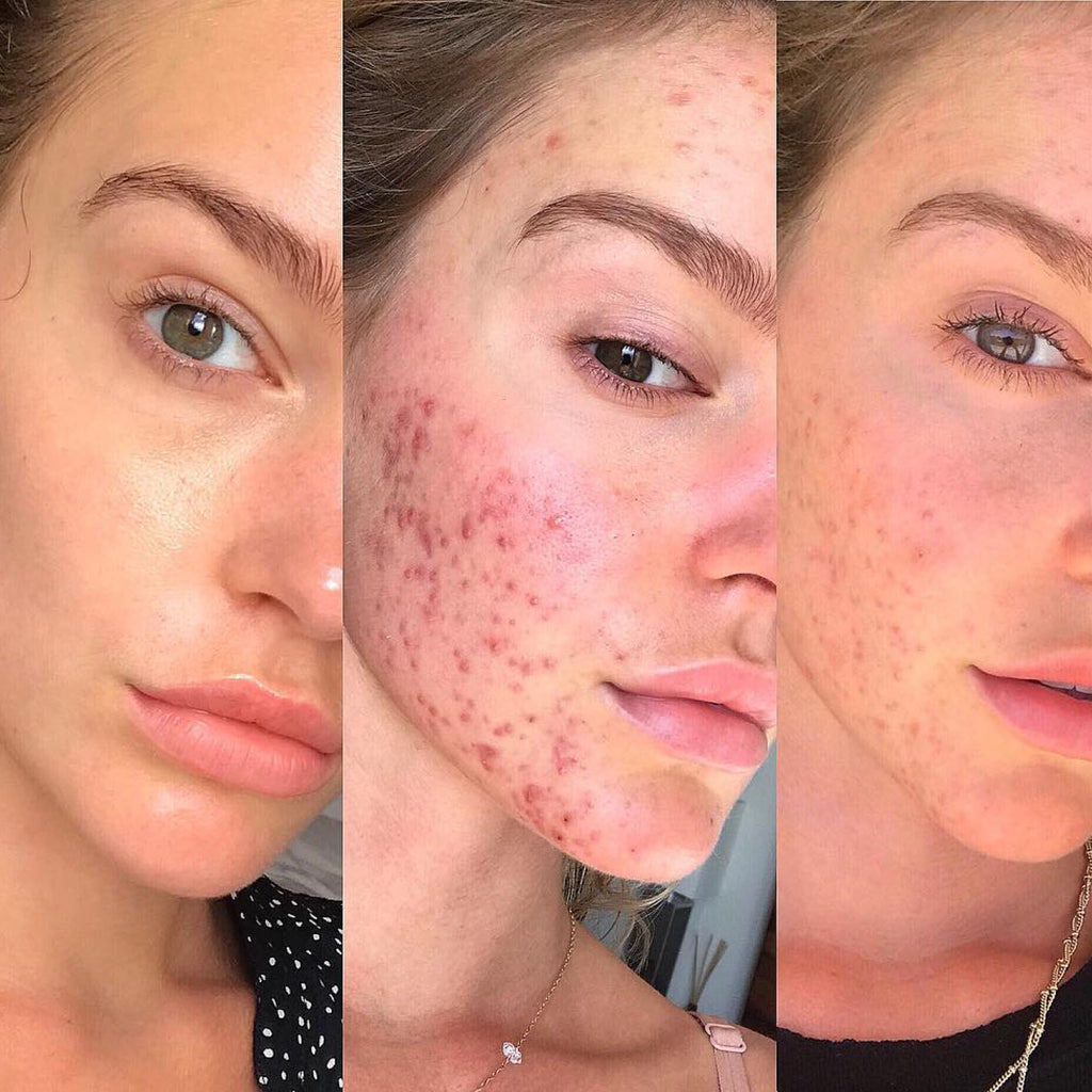 The Proven Link Between Acne and Diet